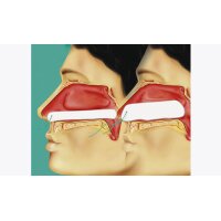 Raucocel® Stirnband, 175mm, 40 x 5mm