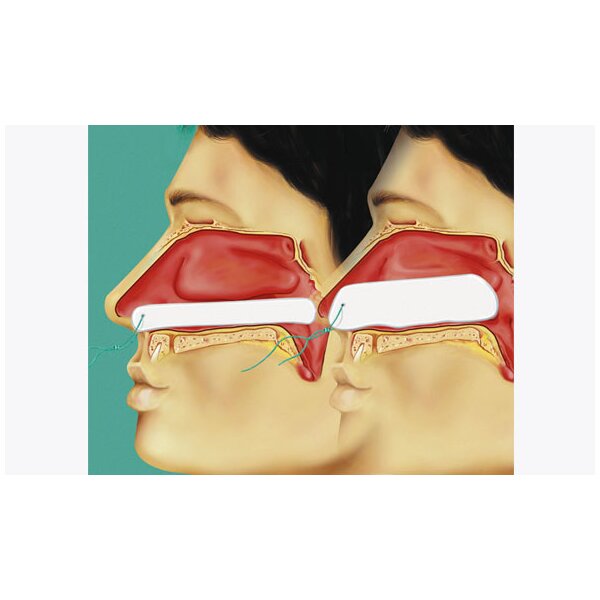 Raucocel® Zubehör, Stirnband, 175mm, 40 x 5mm